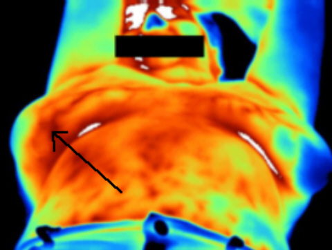 Breast Cancer in lower Right breast.